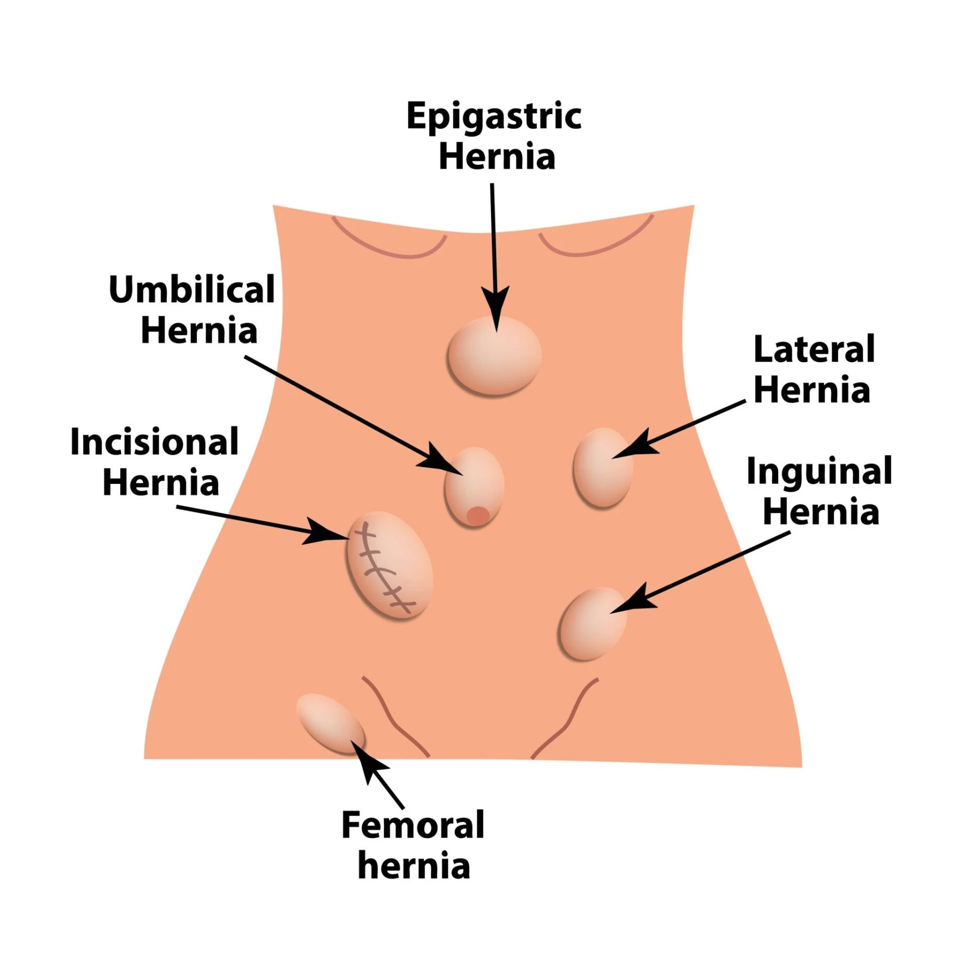 Understanding Hernia: Causes, Symptoms, and Finding the Best Care in Delhi