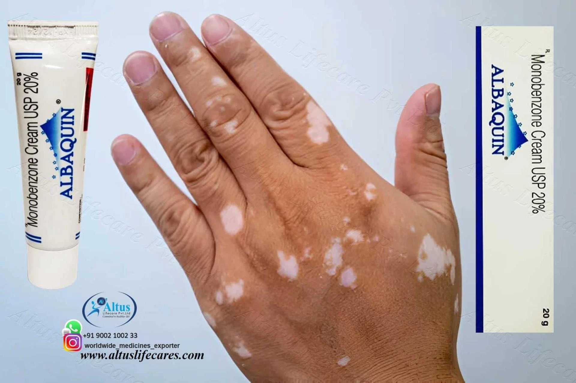 Albaquin 20 Cream Monobenzone for Vitiligo Treatment & White Patches