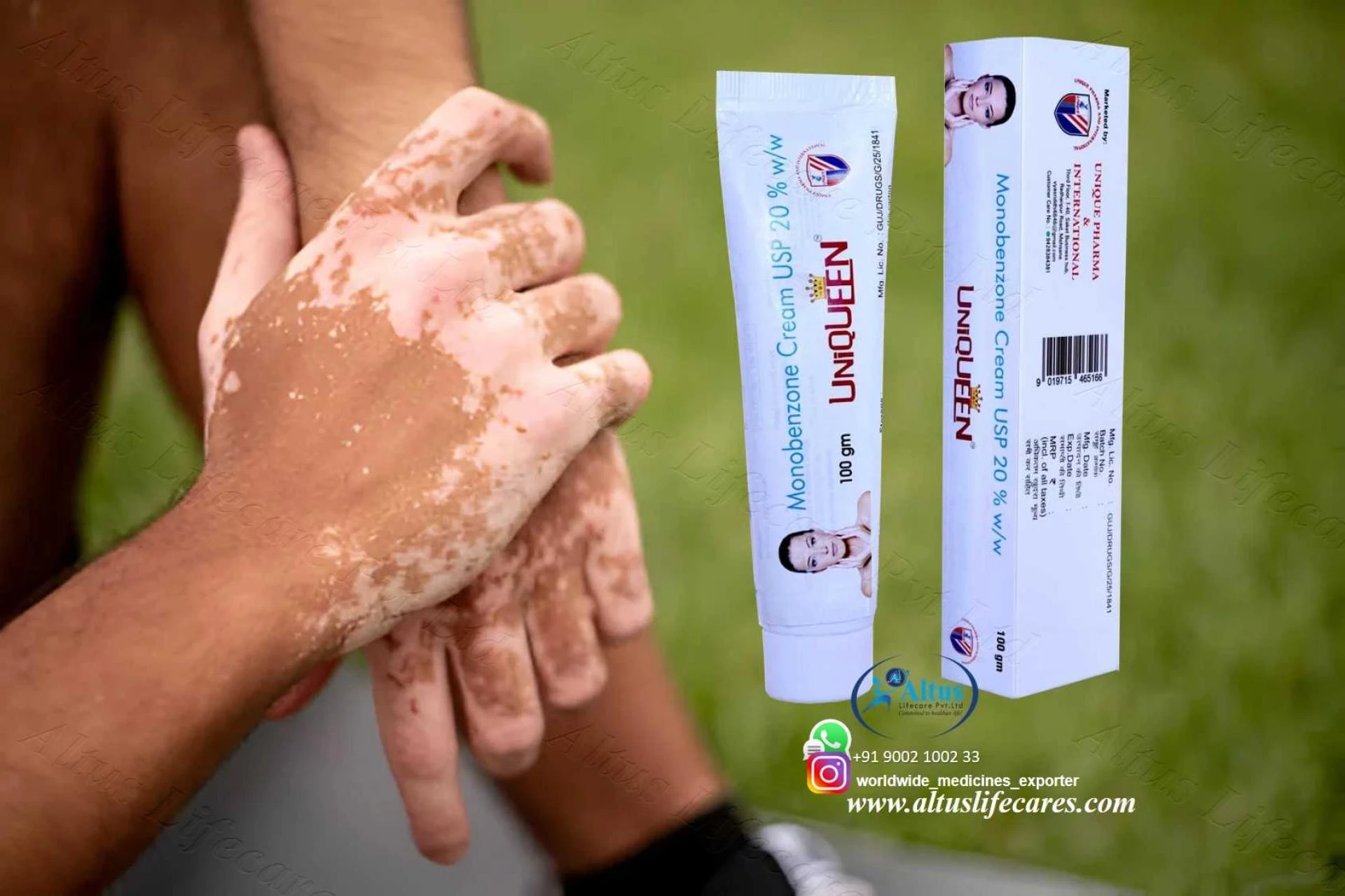 Uniqueen 20 Cream: Powerful Relief for Stubborn Vitiligo