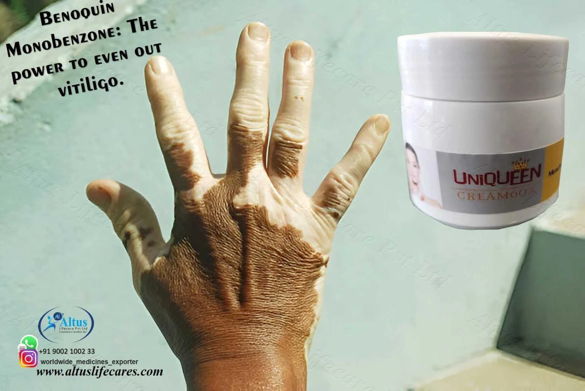 Uniqueen 60% Cream: Advanced Care for Tough Vitiligo Skin
