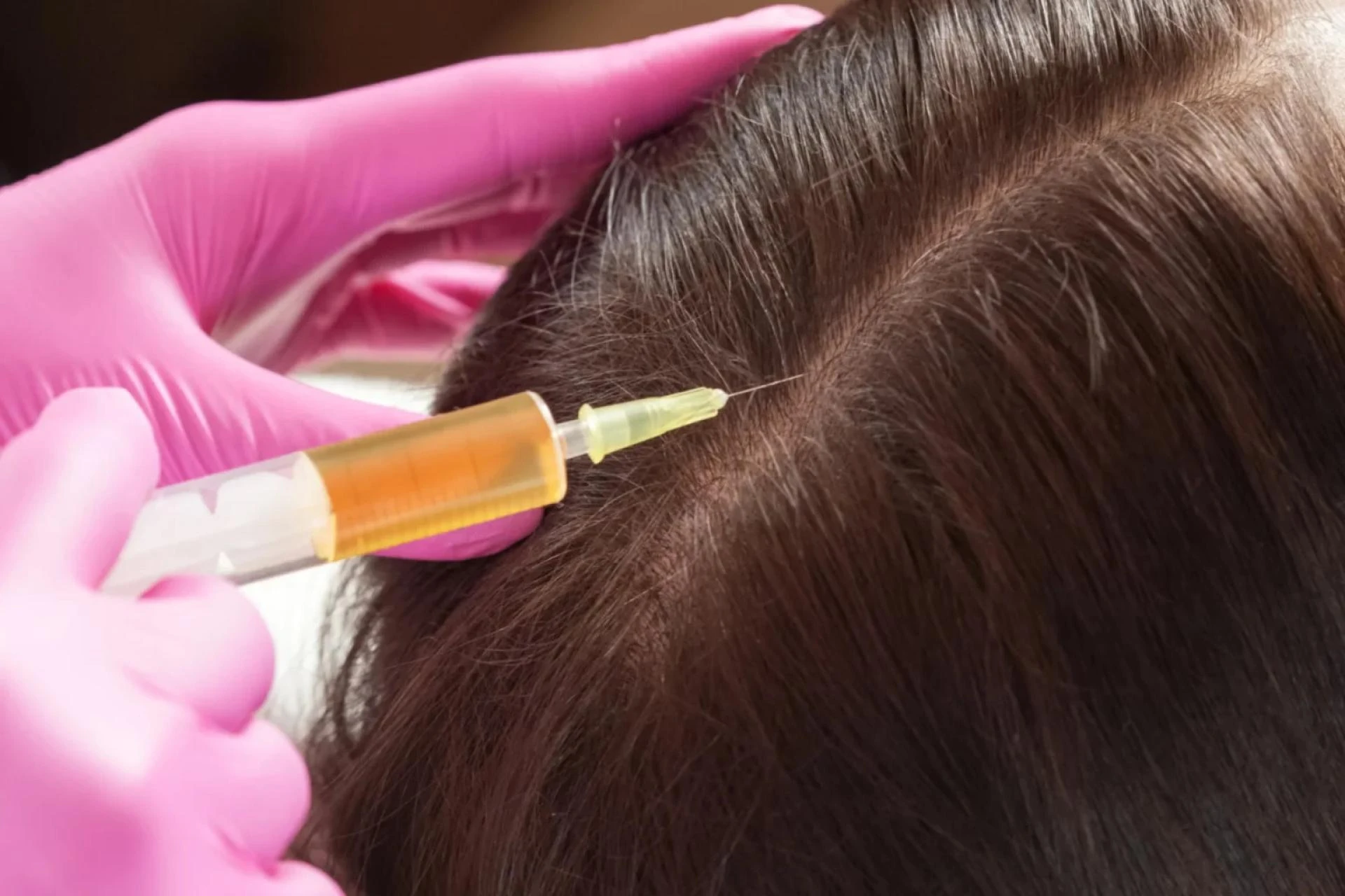 GFC Treatment in Kochi A Modern Solution for Hair Loss and Thinning Hair