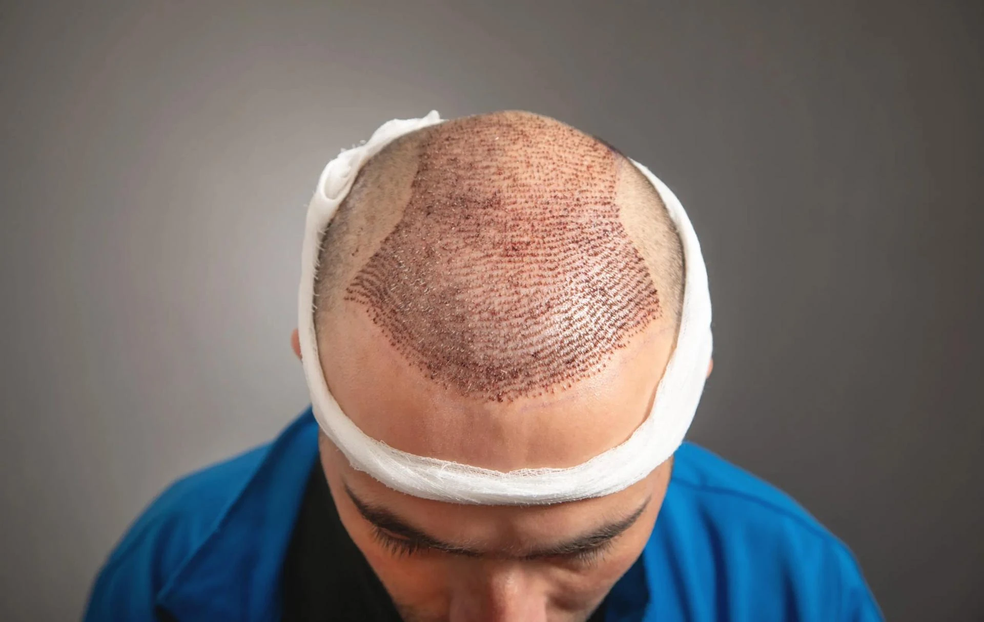 Hair Transplant – Cost, Procedure, Safety, and Results Explained