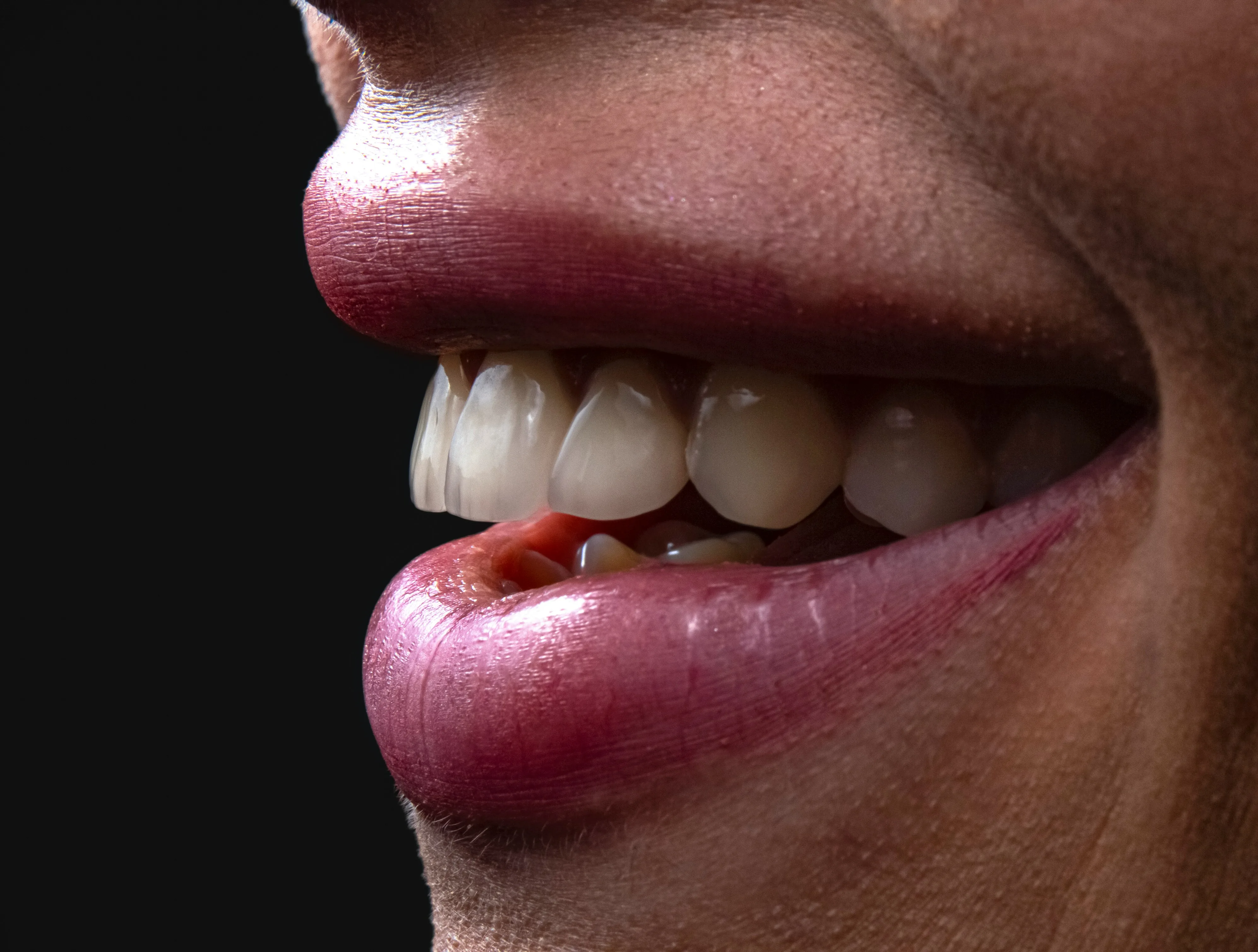 Full Mouth Reconstruction in The Colony