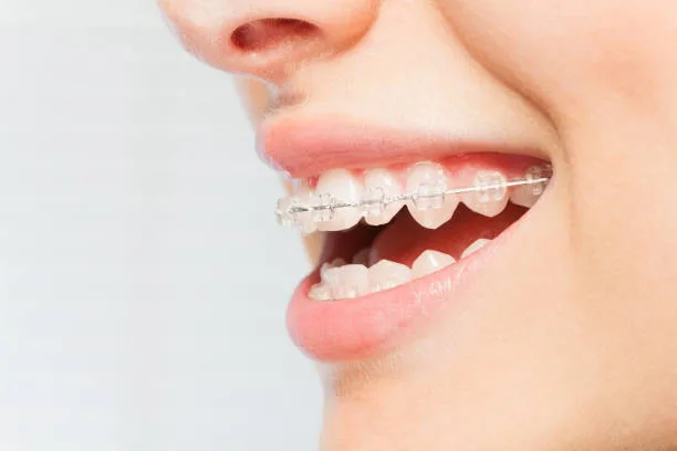 Making treatment more accessible with affordable braces near me