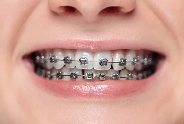 Planning treatment with affordable braces near me and personalized care