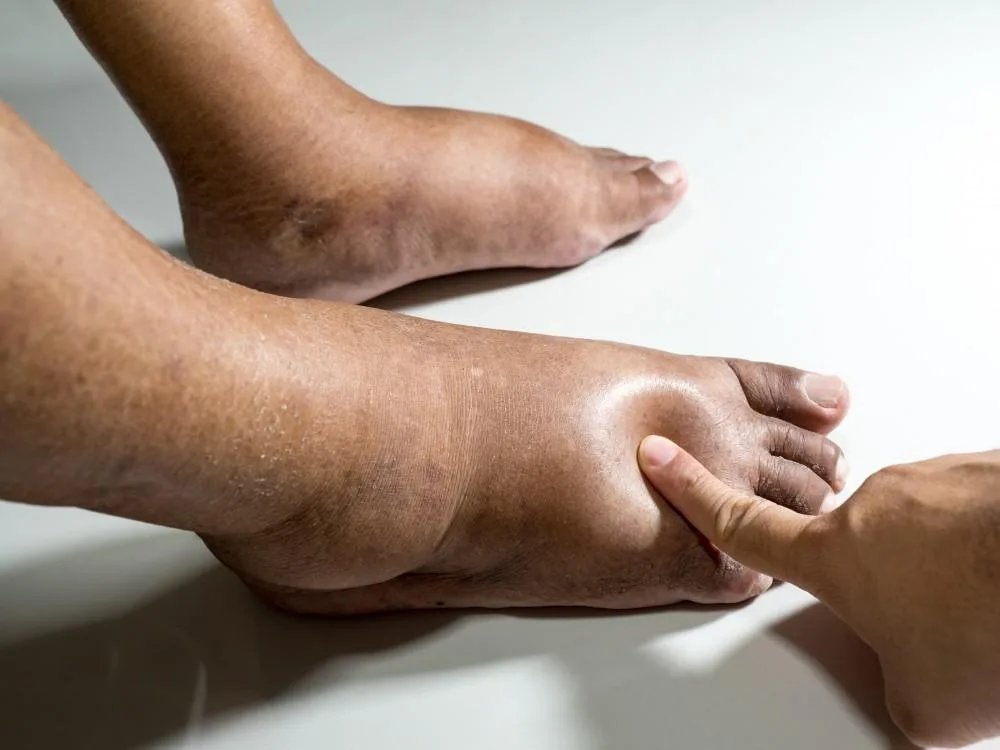 Sclerotherapy Dubai and Varicose Vein Care in the UAE