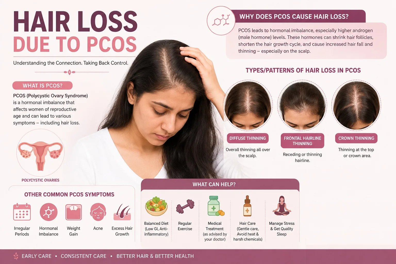 Hair Loss Due to PCOS: Causes & Treatment
