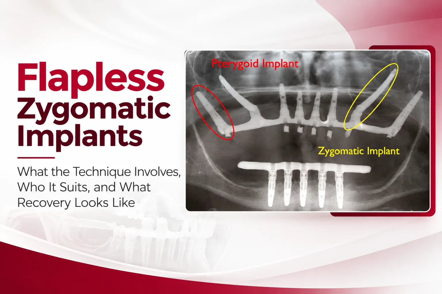Flapless Zygomatic Implants: What the Technique Involves, Who It Suits, and What Recovery Looks Like