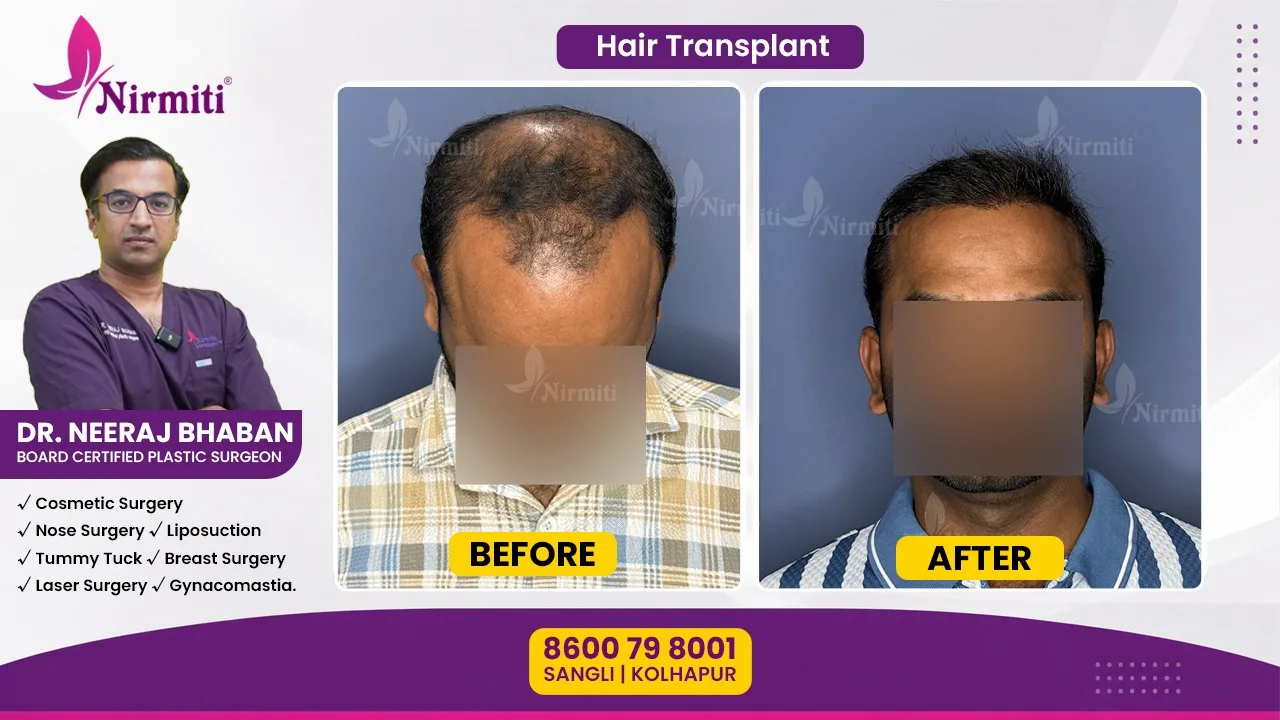 Hair Transplant Before and After: Recovery, Results, and Common Myths Explained