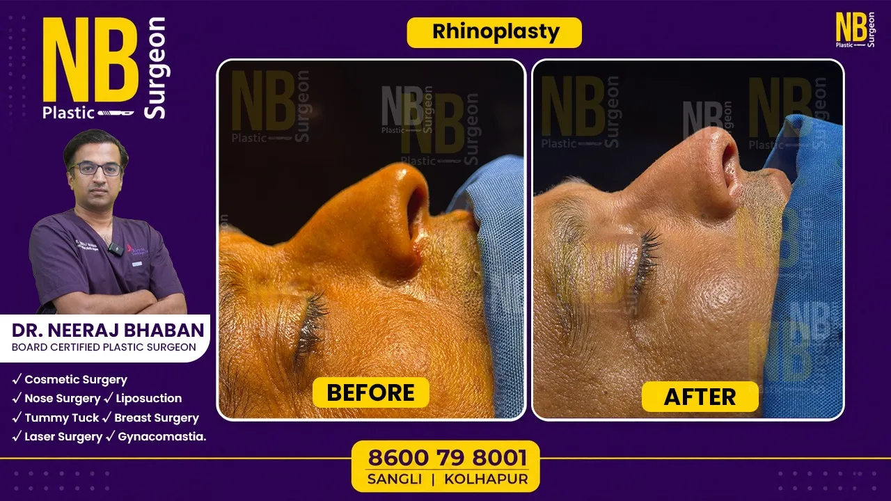 Cosmetic Rhinoplasty vs. Functional Rhinoplasty: Which Procedure Is Right for You?