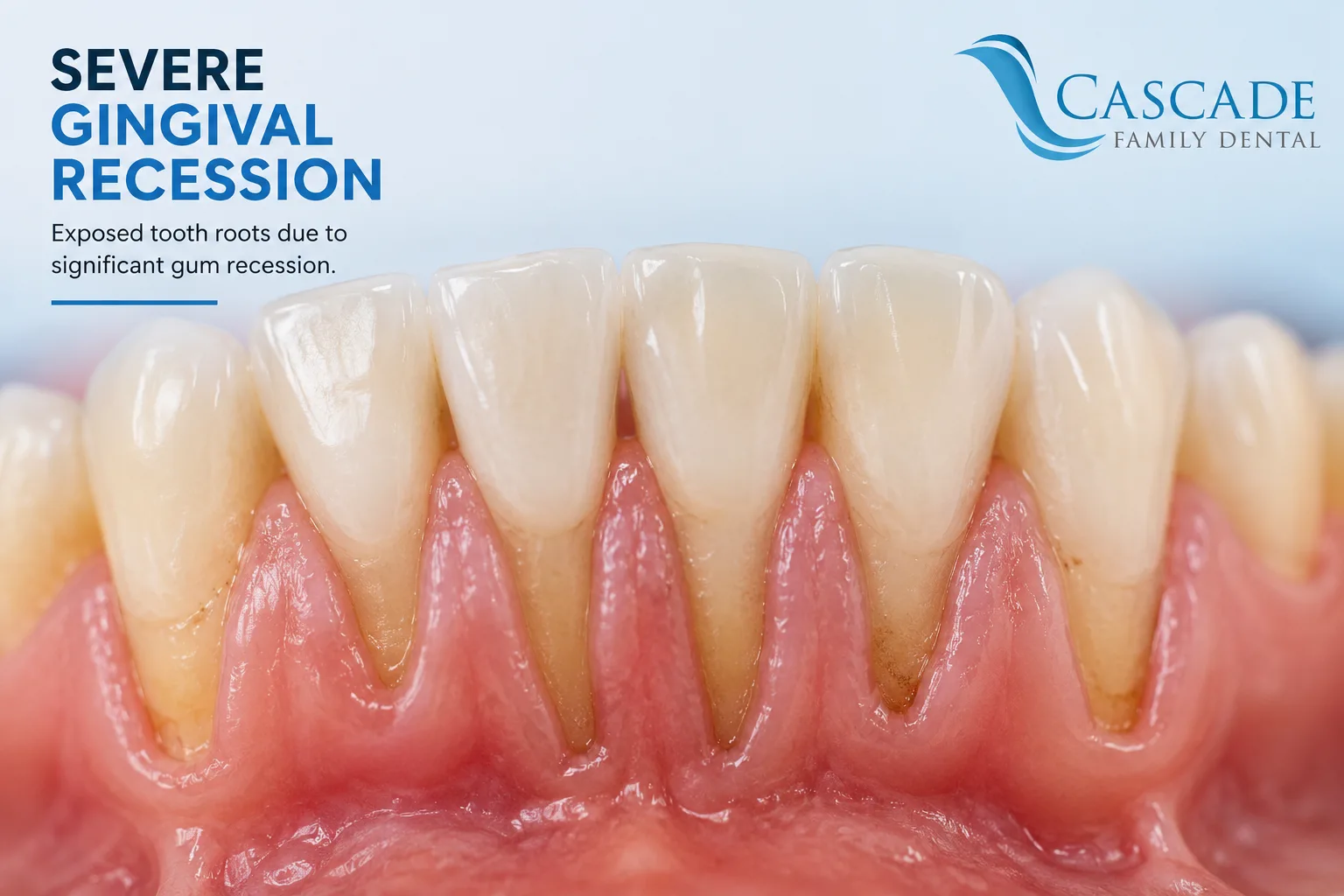 Severe Gingival Recession: What Your Gums Are Trying to Tell You