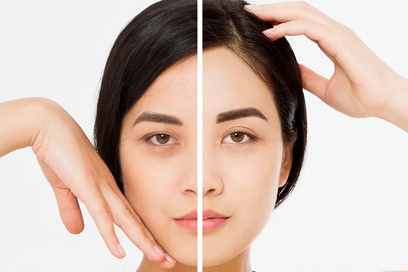 Endoscopic Forehead Lift in UAE: The Quiet Fix for Faces That Always Look Tired