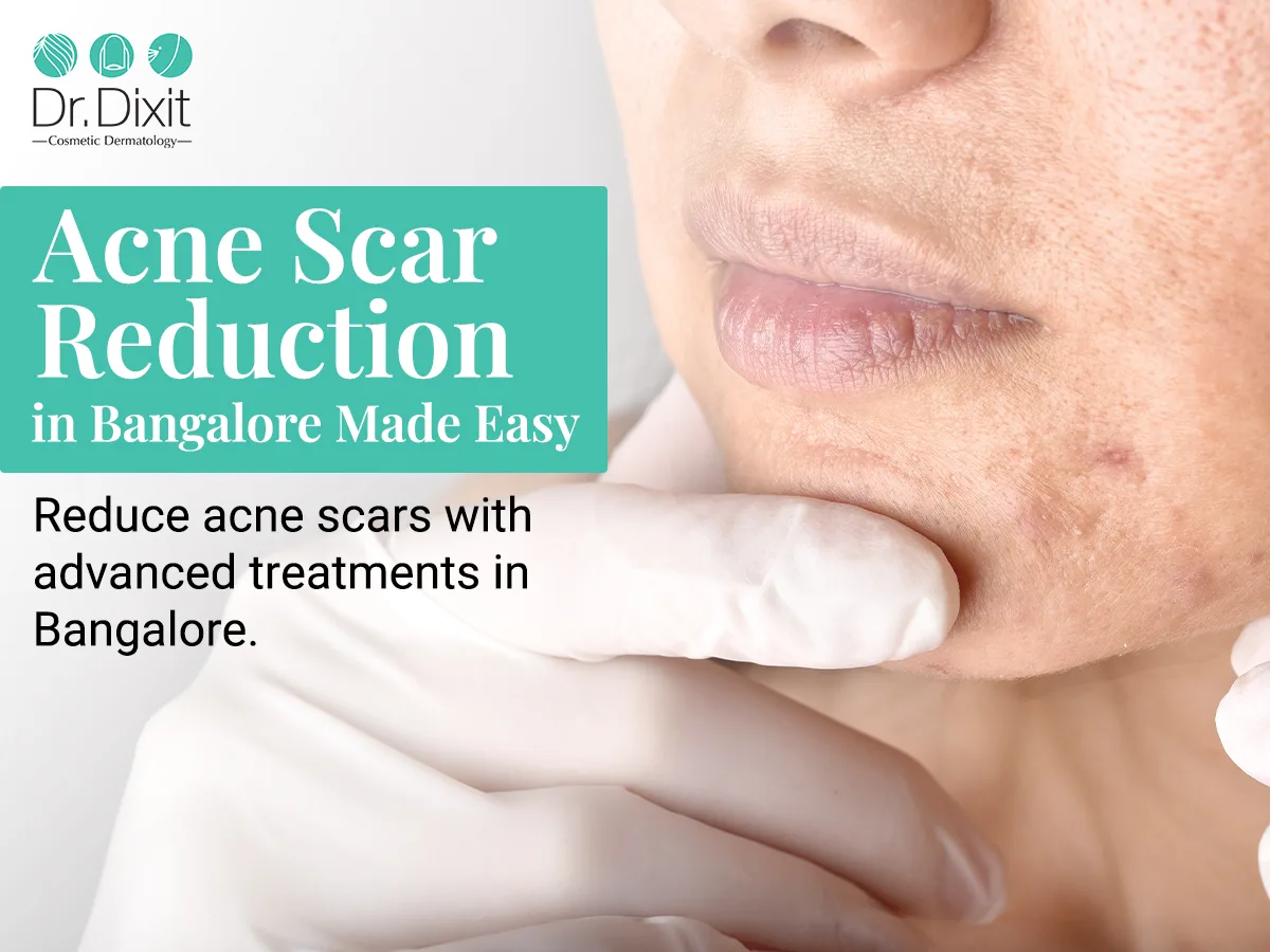 MNRF Treatment: How Effectively It Helps in Acne Scar Management