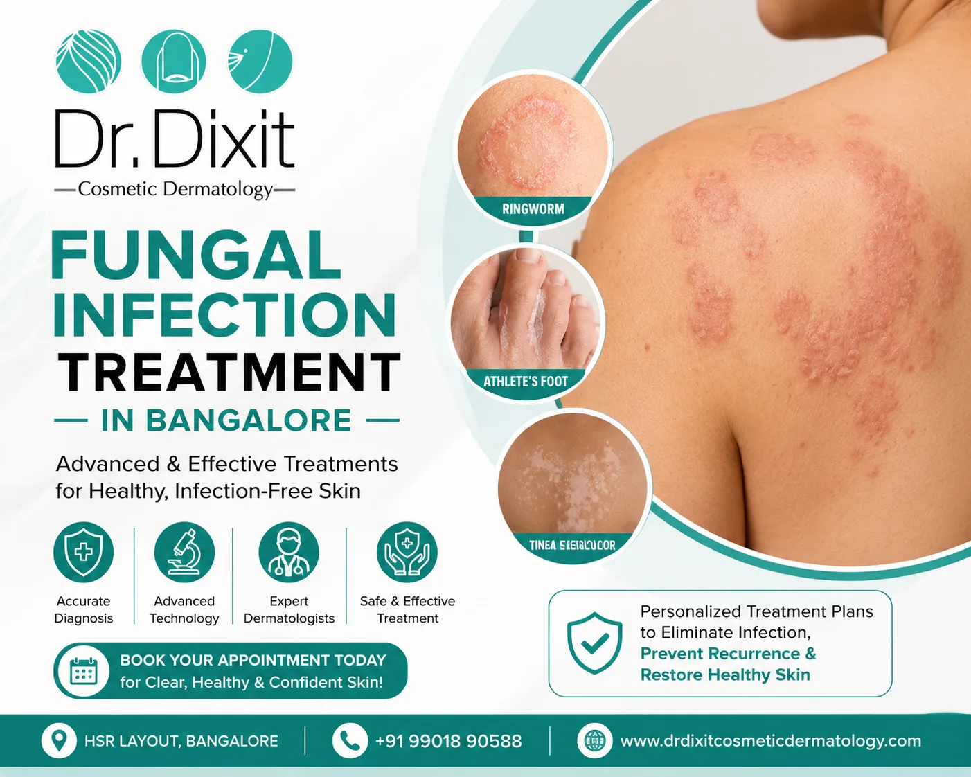 White Patches on Skin: Fungal Infection or Something Else?