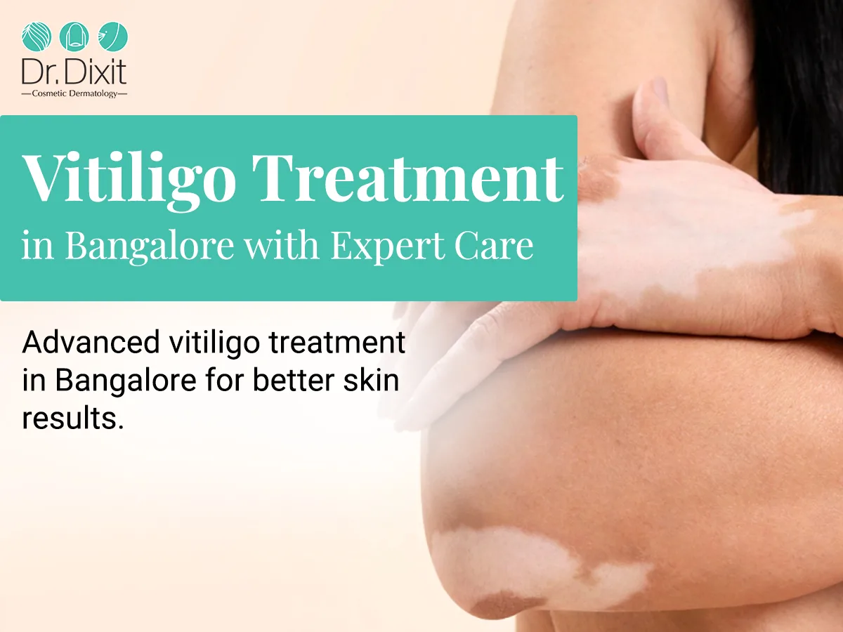 Can Vitiligo Be Treated Successfully? Understanding What Patients Can Realistically Expect