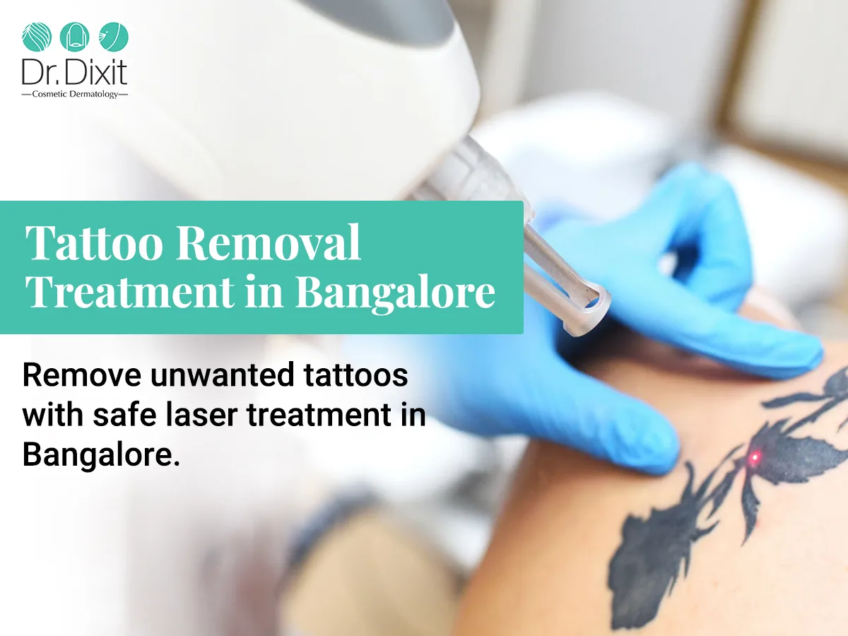 Which Laser Technology Can Help in Tattoo Removal?