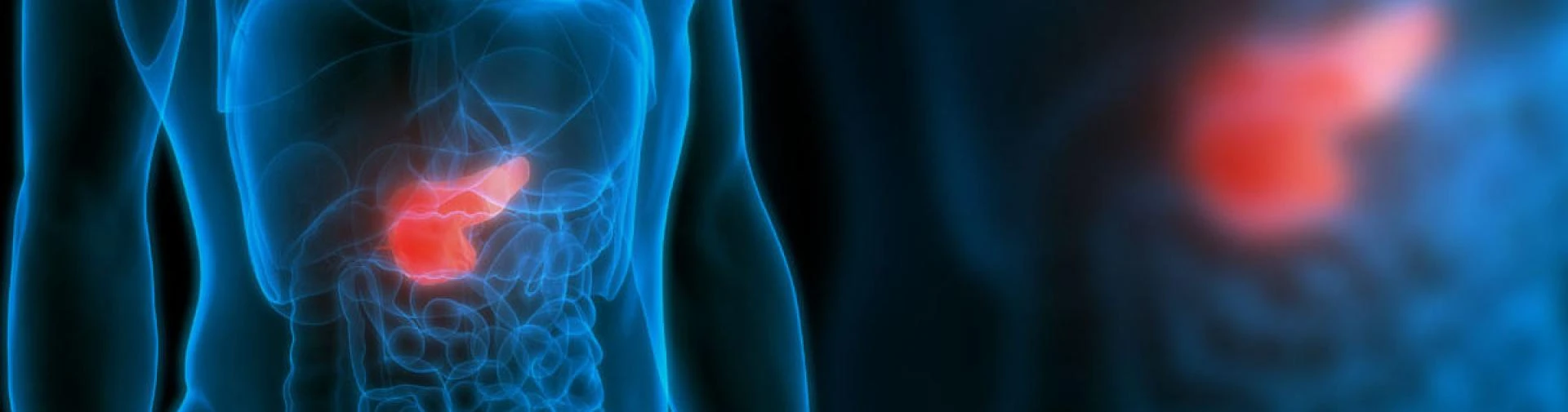 PANCREATIC Cancer SINGAPORE