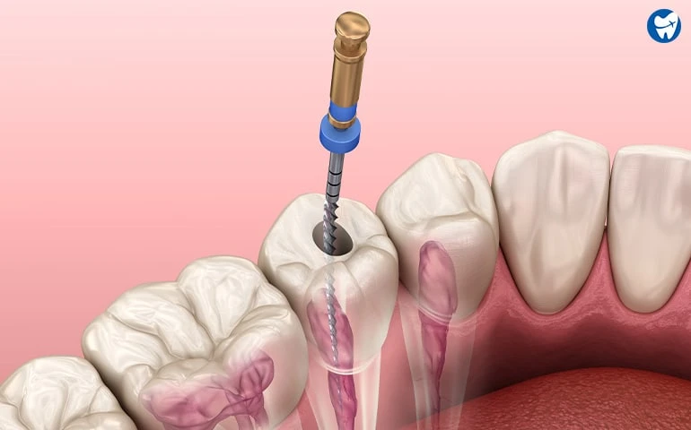 Root Canal Treatment: Procedure and Cost (With - Without Insurance)