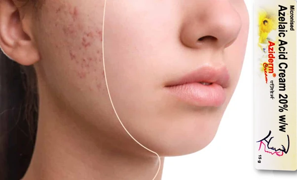 Azelaic Gel 20%: The Secret to Your Best Skin Ever!