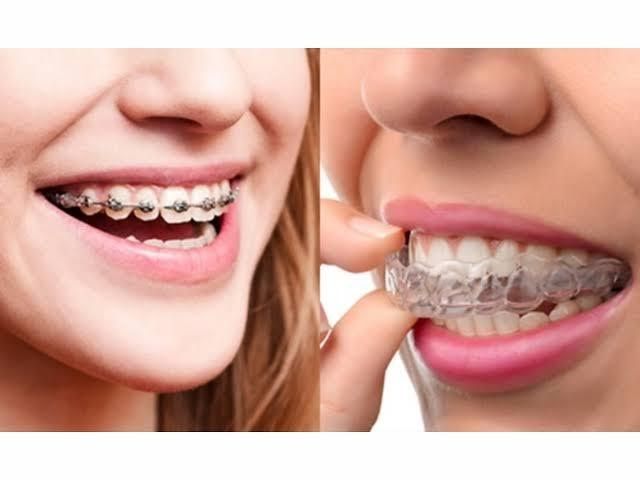 12 Facts about Invisalign You Need to Know