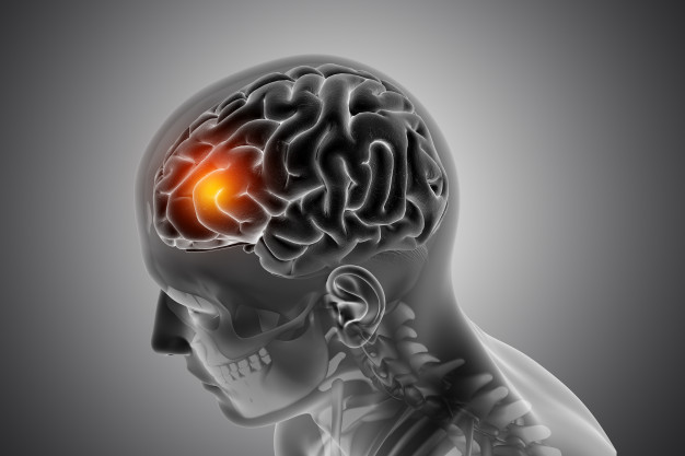 Brain Tumor: Causes, Types, and Symptoms