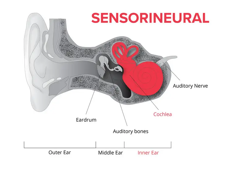 Audien Hearing Comes Out with Three Major Types of Hearing Misfortune