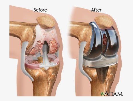 Names of some amazing knee joint replacement surgeons in India