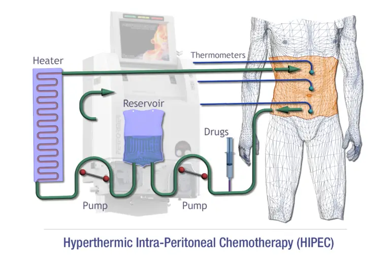 HIPEC Treatment In India – Surgery Cost & Treatment Procedure