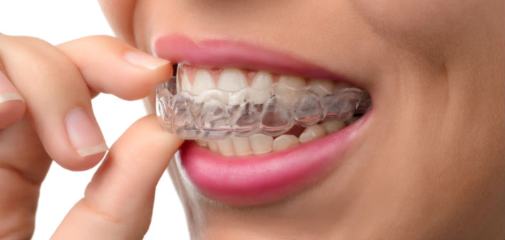 Invisalign Retainer After Treatment