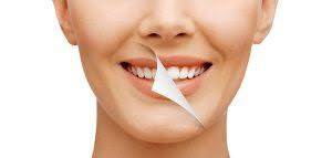 Things You Should Know About Opalesence Tooth Whitening