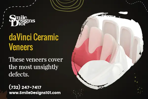 What are the costs of dental veneers in Somerset, NJ?
