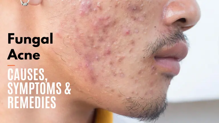 Fungal acne- causes, symptoms & remedies