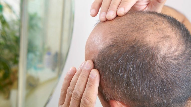 Latest Technology for Hair Transplant to Avoid Balding