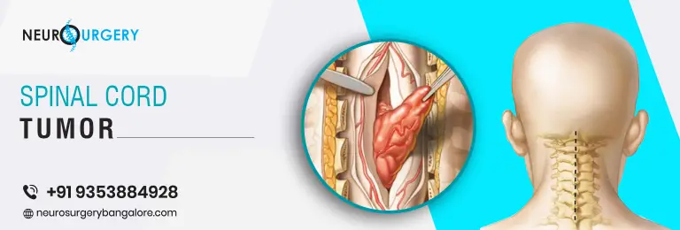 Spinal cord tumours are abnormal cells