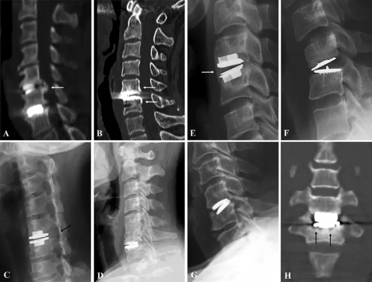 Is Disc Replacement Better Than Fusion?