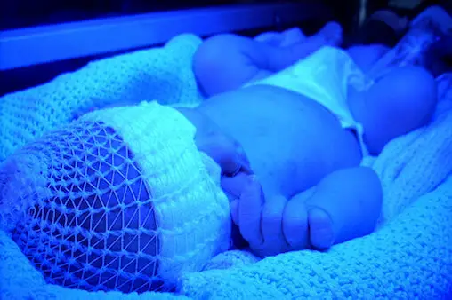 How To Work Hard In Jaundice Treatment And How?