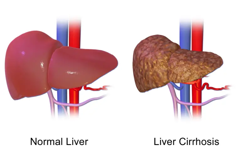 Liver Disease – Types of Medical Conditions Affecting the Liver