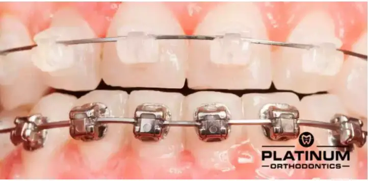 Different Types Of Braces - TheOmniBuzz