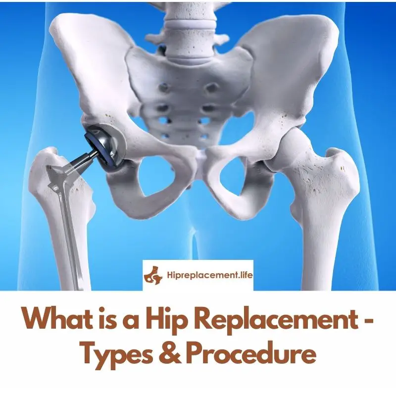 What is a Hip Replacement – Types & Procedure - TheOmniBuzz