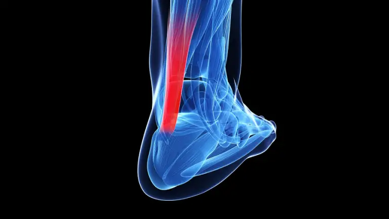 Achilles Tendonitis – Symptoms, Treatment & Recovery