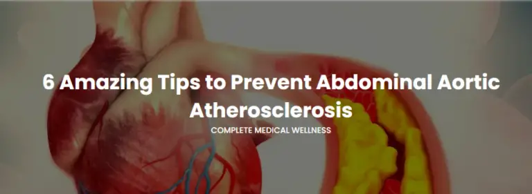 6 Amazing Tips to Prevent Abdominal Aortic Atherosclerosis