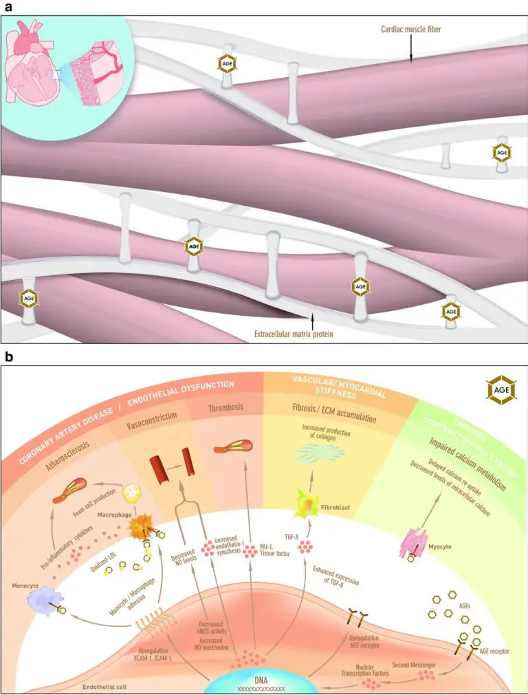 Alzheimer's patients have Type 2 diabetes, which is associated with increased Advanced Glycation End Products (AGEs) and increased expression of the AGED receptor.