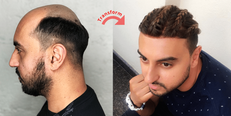 A Complete Guide On Non-Surgical Hair Replacement Options For Men