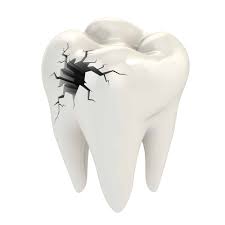 Cracked teeth can cause extreme tooth ache if left untreated