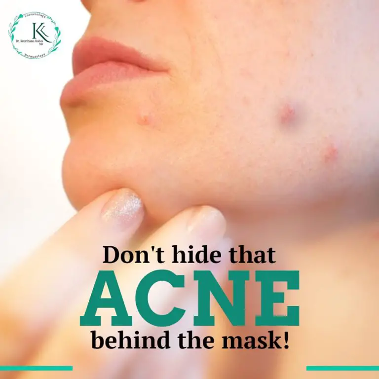 Acne Treatment cost in Hyderabad