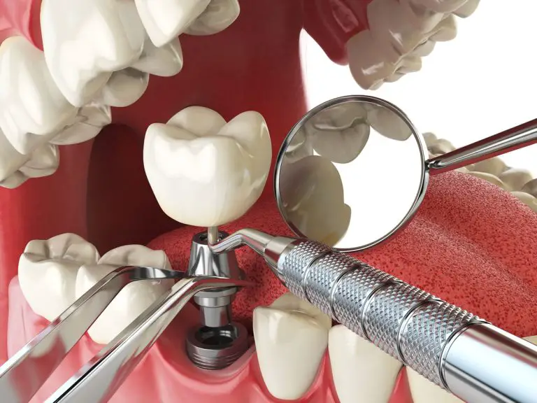 What are the different dental implants, and how do they differ