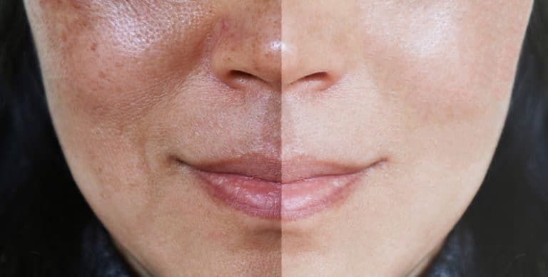 best treatment for pigmentation on face