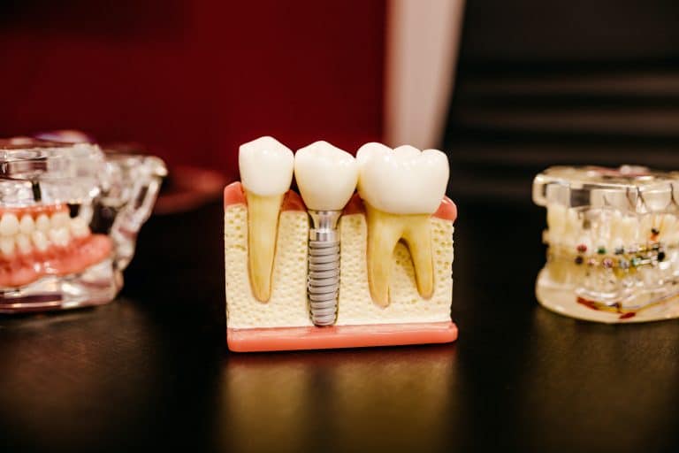 Lifespan of dental implants NZ