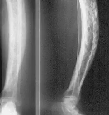 Paget’s bone disease- Symptoms and Treatment