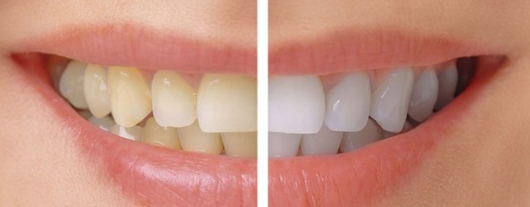 Planning to Get Your Teeth Whitened? Here is What You Need to Know